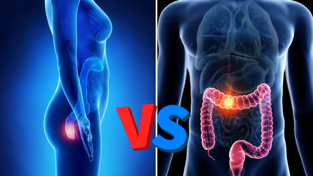 Hemorrhoid Vs Colon Cancer