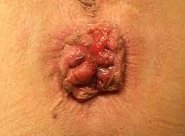 What hemorrhoid look like