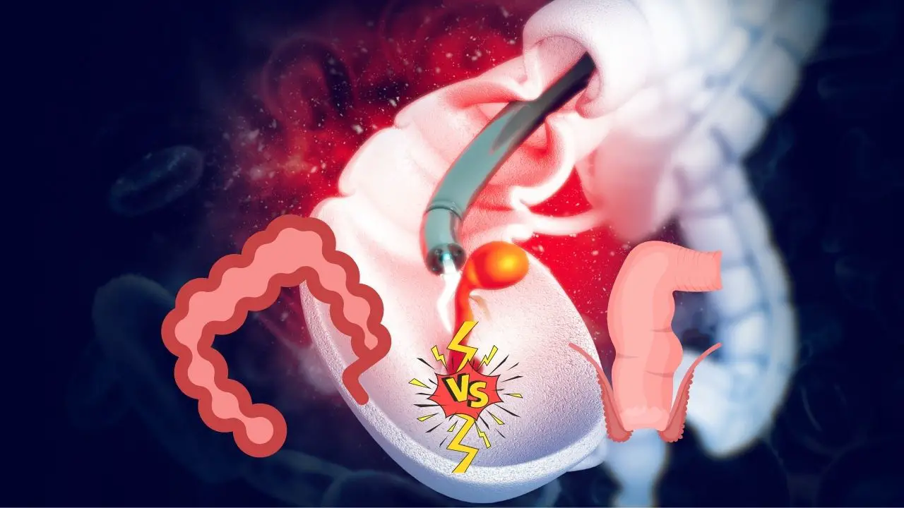 Hemorrhoids vs polyps