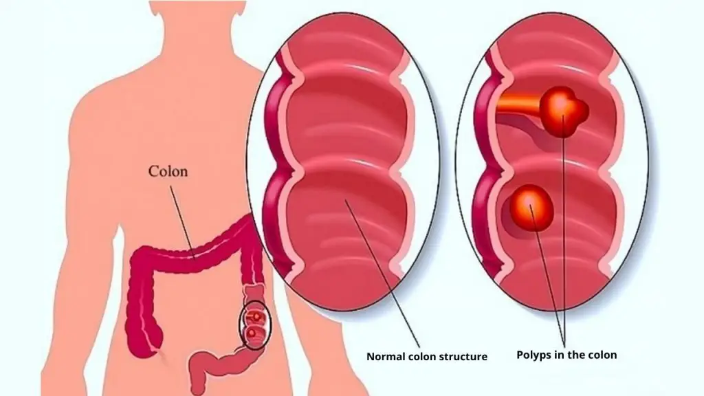 Hemorrhoids vs polyps