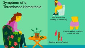 Hemorrhoids blood clot - Hemorroids.org