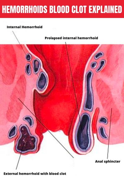 hemorrhoids blood clot