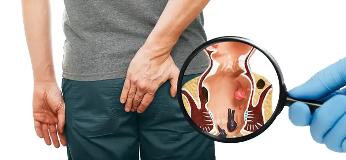 Can hemorrhoids bleed without a bowel movement?